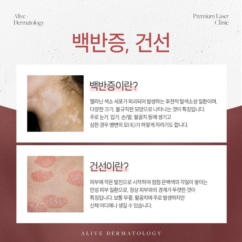 서초백반증레이저 고민이면