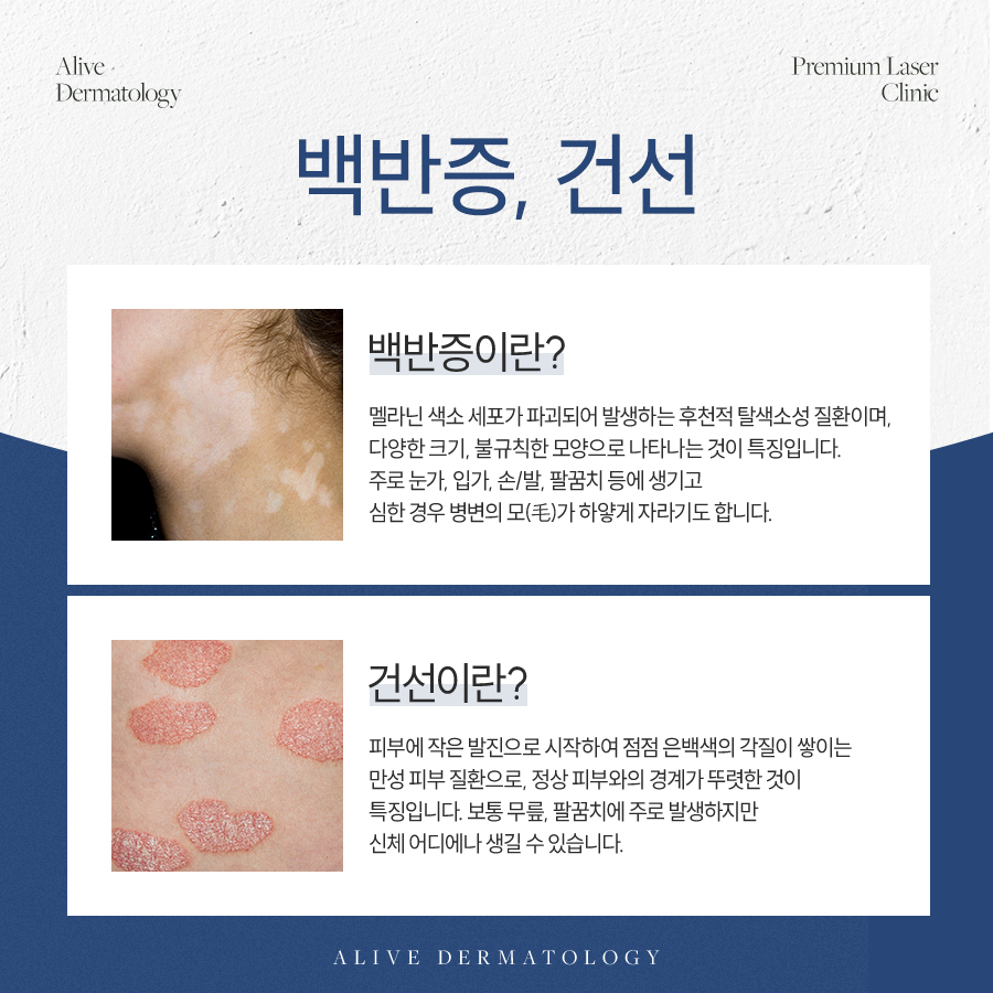 서초구백반증 진행을 막아