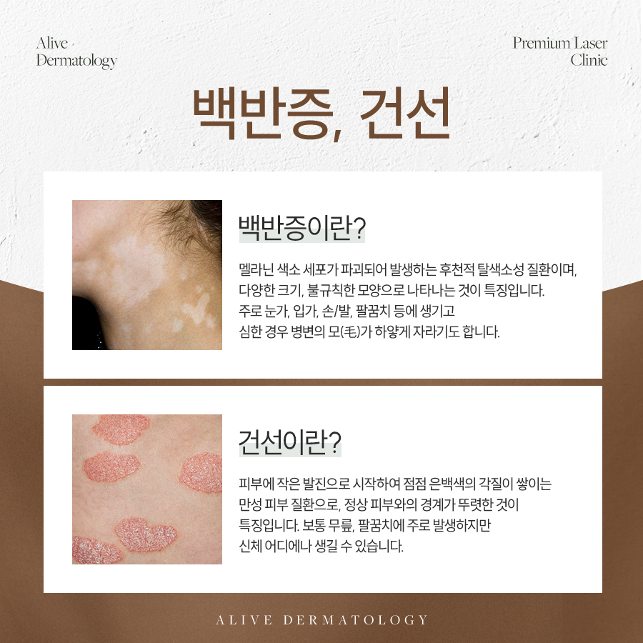 용산백반증 더 심해지기 전에 치료하세요