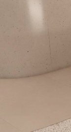 용산백반증 더 심해지기 전에 치료하세요 사진 31