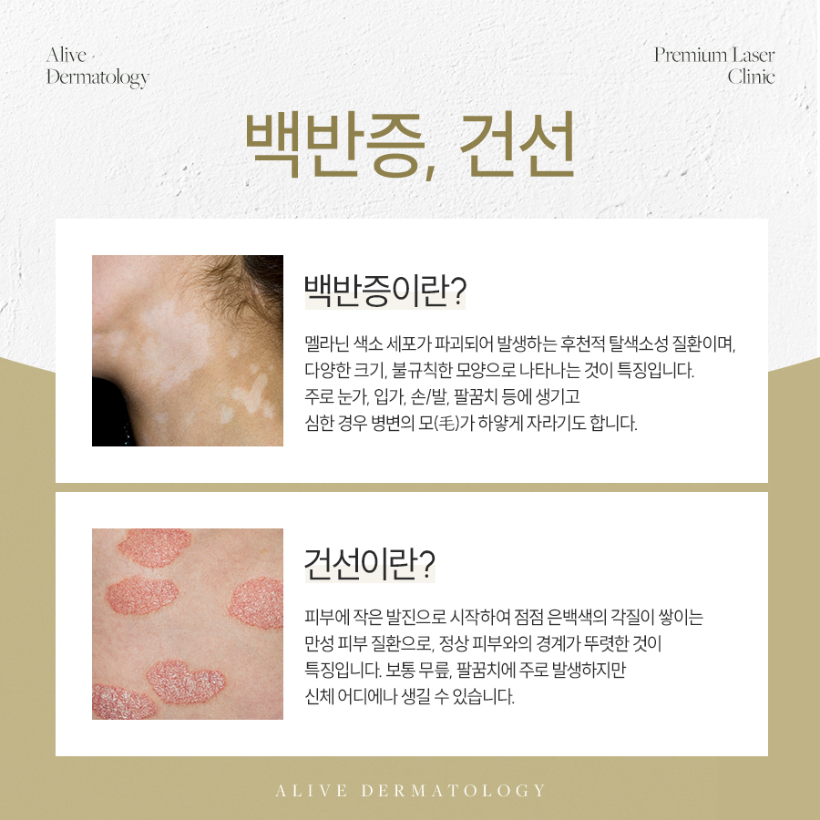 서초동백반증 팔라스 레이저로 치료하세요
