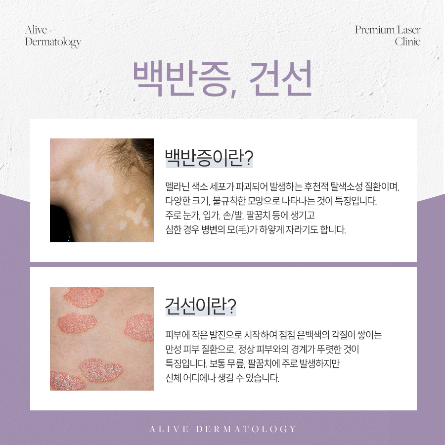 반포역백반증 건선에 좋은 팔라스 레이저의 장점은?