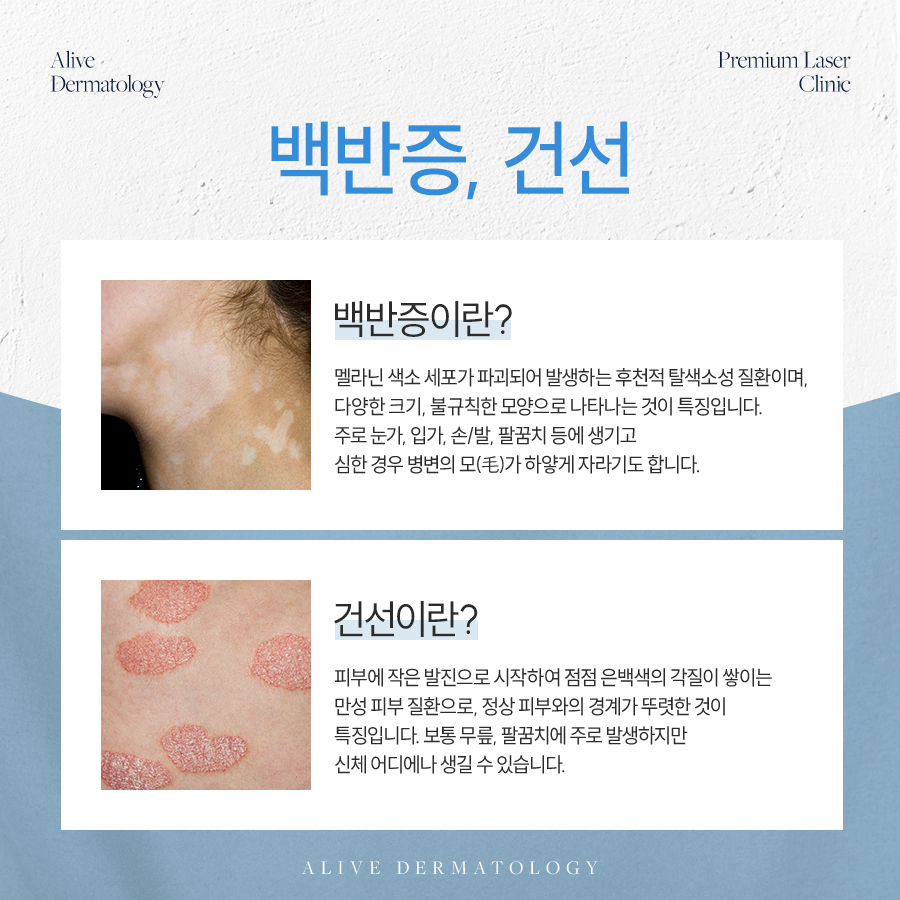 서초건선 개선하는 방법은