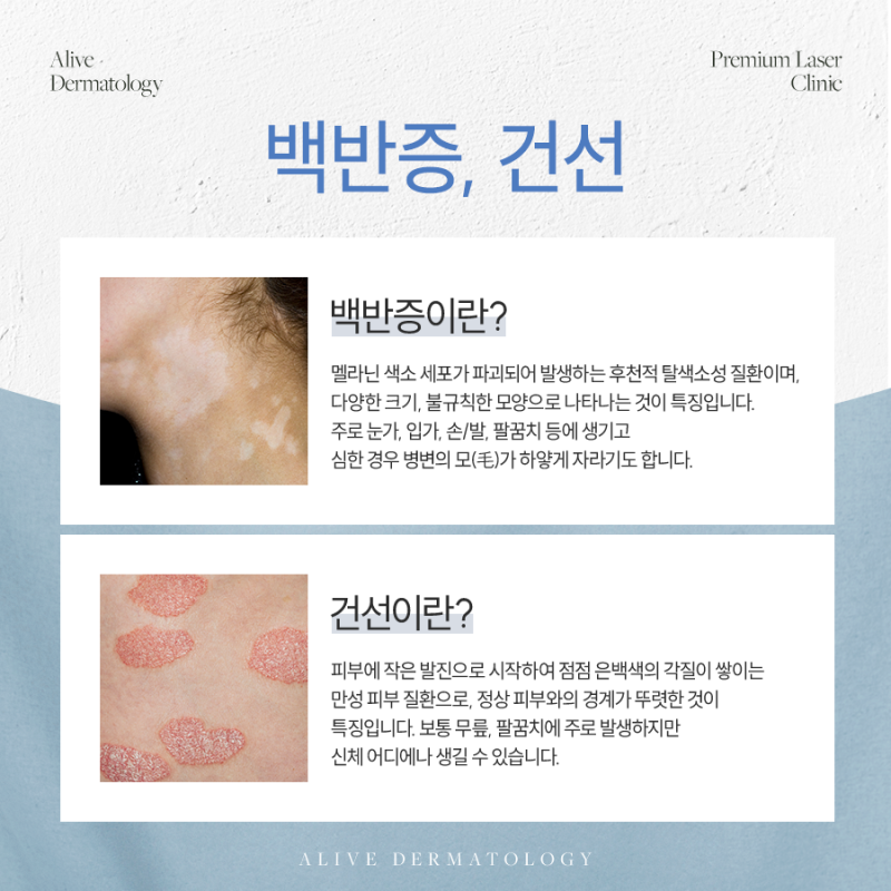 서초백반증, 제대로 파악한 후 관리해야