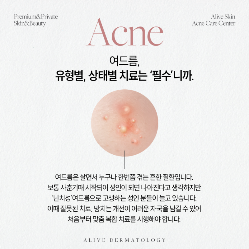 서초동여드름, 스트레스받고 있다면