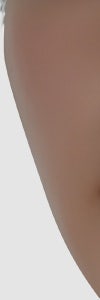 손상된 피부를 되돌리는 방법, 반포동리쥬란힐러 사진 14