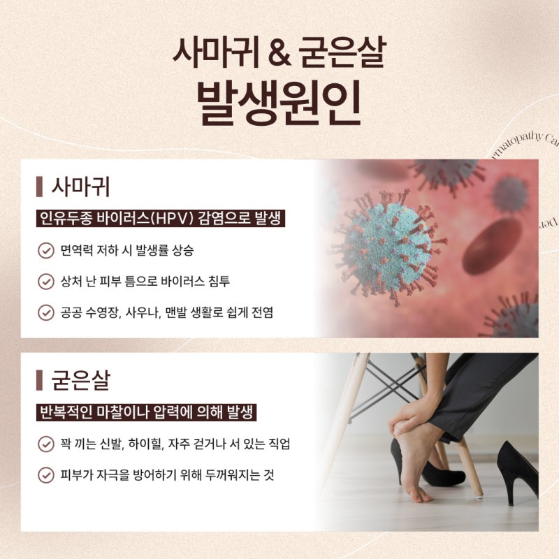 반포사마귀치료, 초기에 정확히 관리해야 하는 이유