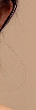 반포사마귀치료, 초기에 정확히 관리해야 하는 이유 사진 12