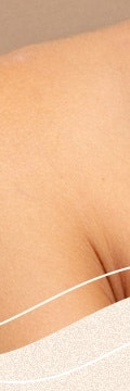 반포사마귀치료, 초기에 정확히 관리해야 하는 이유 사진 16