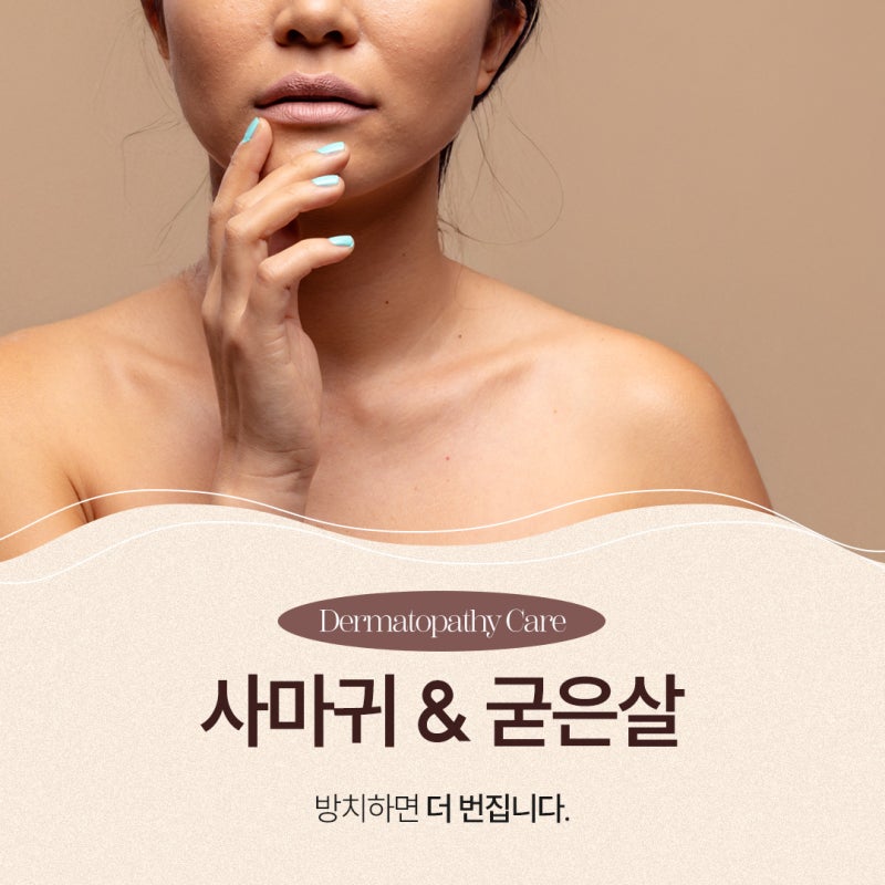 반포사마귀치료, 초기에 정확히 관리해야 하는 이유 사진 2