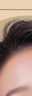 서초흉터치료, 다양한 흉터 유형 사진 10