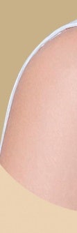 서초흉터치료, 다양한 흉터 유형 사진 27