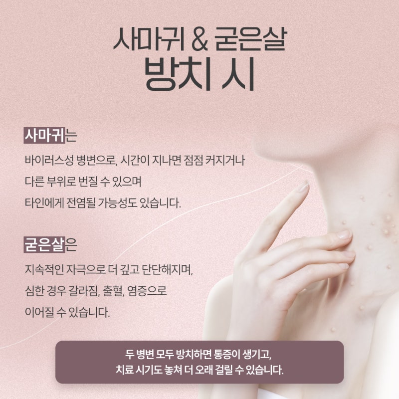 굳은살인 줄 알았는데… 고속터미널역사마귀 의심해야 하는 이유 사진 4