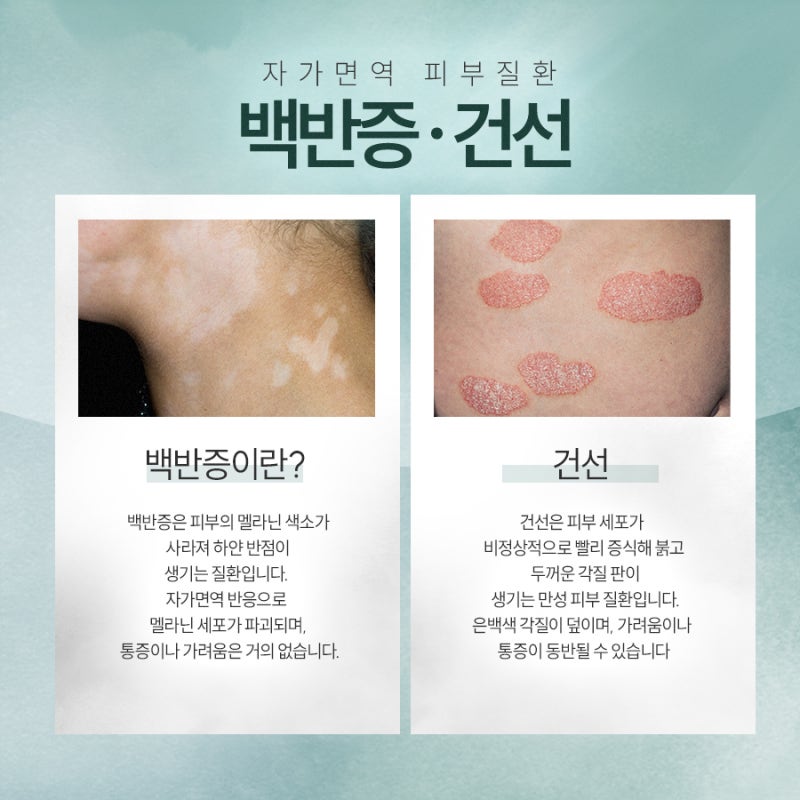 하얀 반점이 고민이라면? 고속터미널역백반증