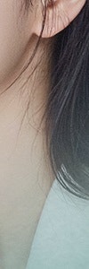 하얀 반점이 고민이라면? 고속터미널역백반증 사진 21