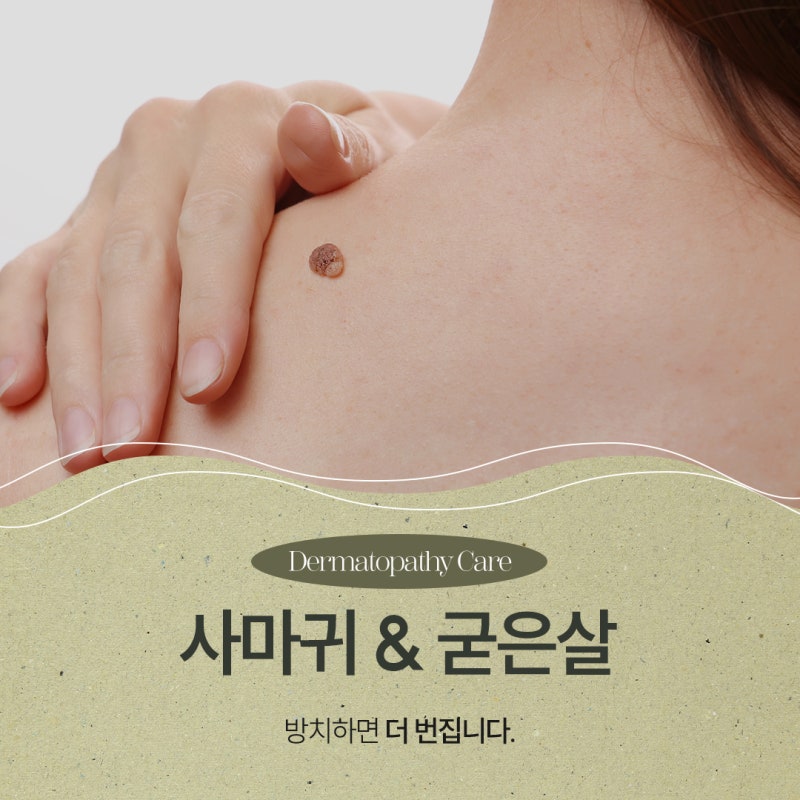 방배사마귀, 굳은살과 헷갈리기 쉬운 이유와 치료의 중요성 사진 2