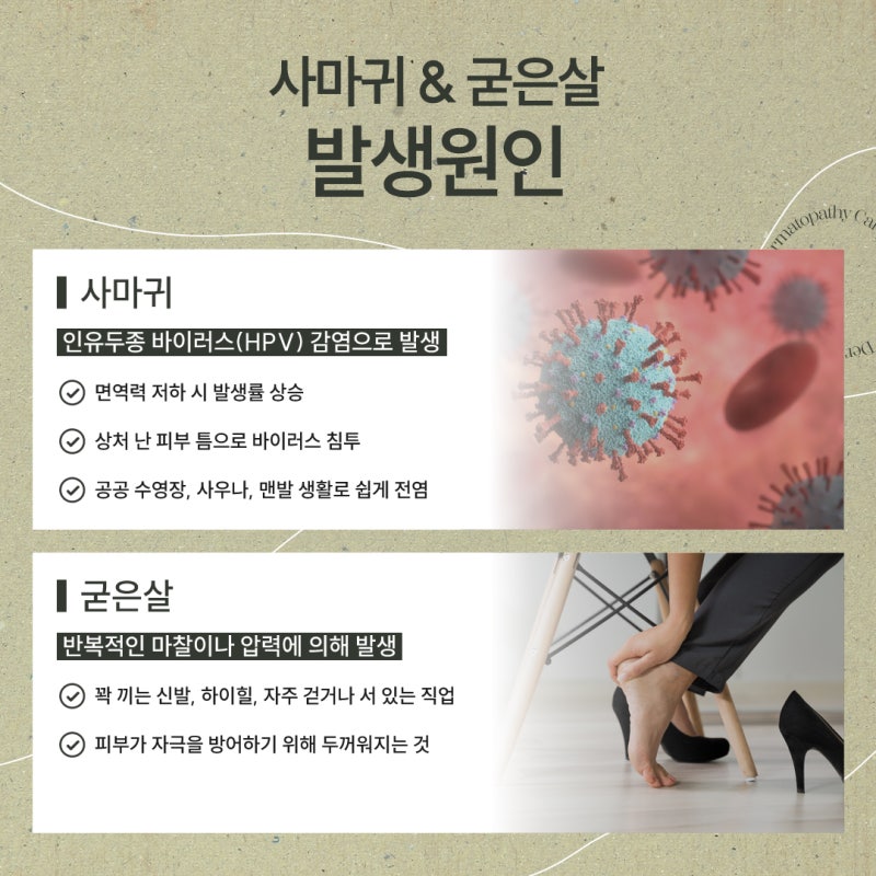 방배사마귀, 굳은살과 헷갈리기 쉬운 이유와 치료의 중요성