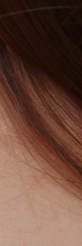 방배사마귀, 굳은살과 헷갈리기 쉬운 이유와 치료의 중요성 사진 15