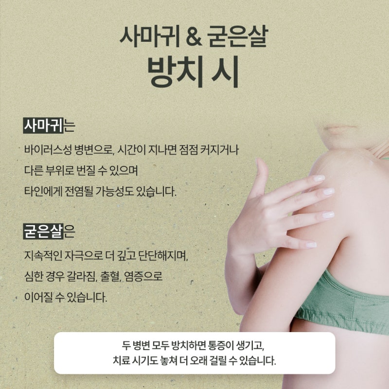 방배사마귀, 굳은살과 헷갈리기 쉬운 이유와 치료의 중요성 사진 4