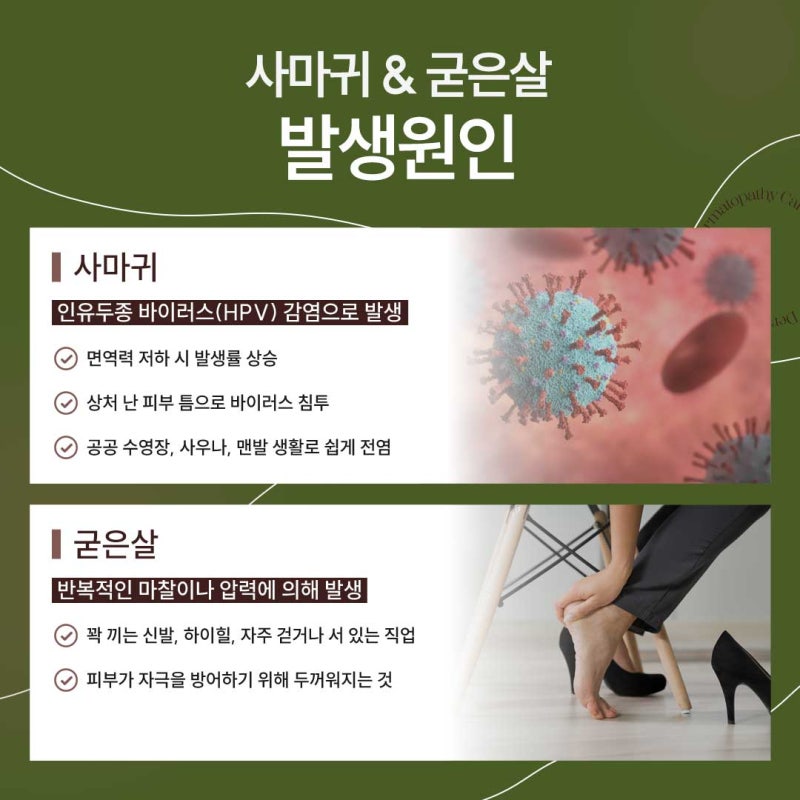 신반포역사마귀, 정확한 진단이 필요한 이유