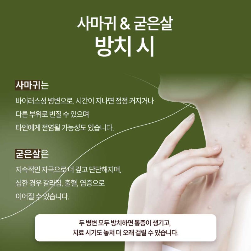 신반포역사마귀, 정확한 진단이 필요한 이유 사진 4