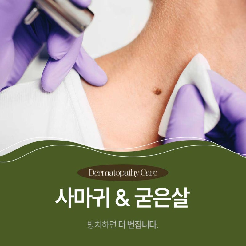 신반포역사마귀, 정확한 진단이 필요한 이유 사진 2