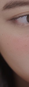 다양한 색소질환을 한번에, 신반포역색소치료 사진 17