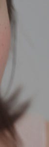 다양한 색소질환을 한번에, 신반포역색소치료 사진 20