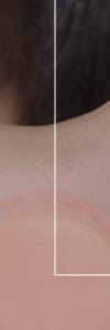 다양한 색소질환을 한번에, 신반포역색소치료 사진 25