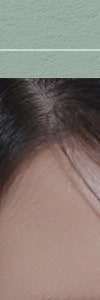 다양한 색소질환을 한번에, 신반포역색소치료 사진 8
