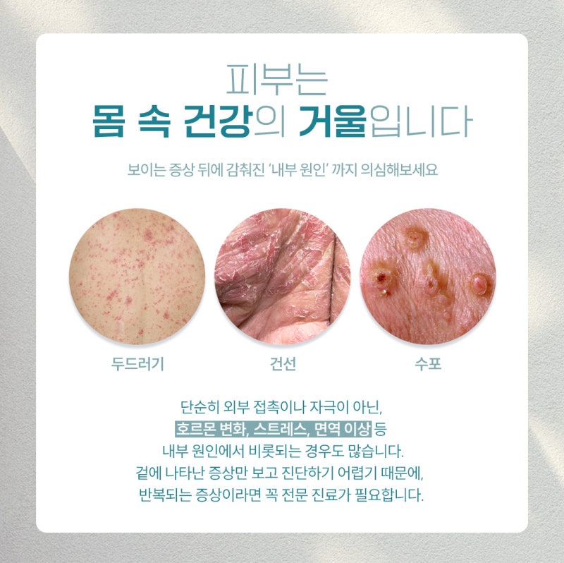 고속터미널피부질환 가렵고 따가운 증상, 무시하면 안 되는 이유?