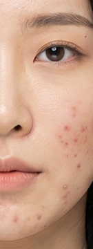 반포여드름치료 고민되는 순간 사진 20