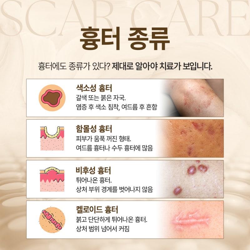 방배흉터치료 전, 고려해야할 부분 정리 사진 4