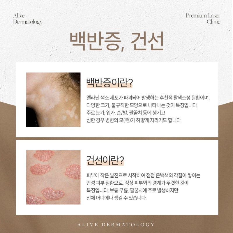 피부에 하얀 반점이 커지기 시작했다면, 동작백반증치료