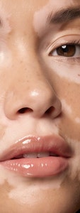 피부에 하얀 반점이 커지기 시작했다면, 동작백반증치료 사진 20