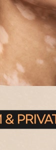 피부에 하얀 반점이 커지기 시작했다면, 동작백반증치료 사진 27