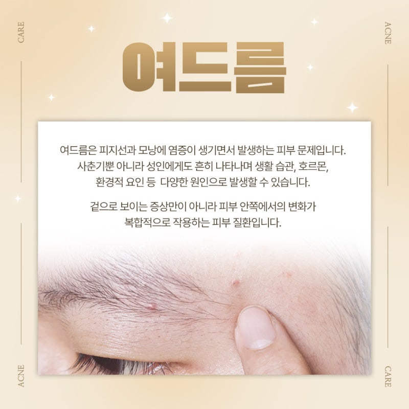 반복되는 여드름 고민을 줄이는 습관, 방배여드름프로그램