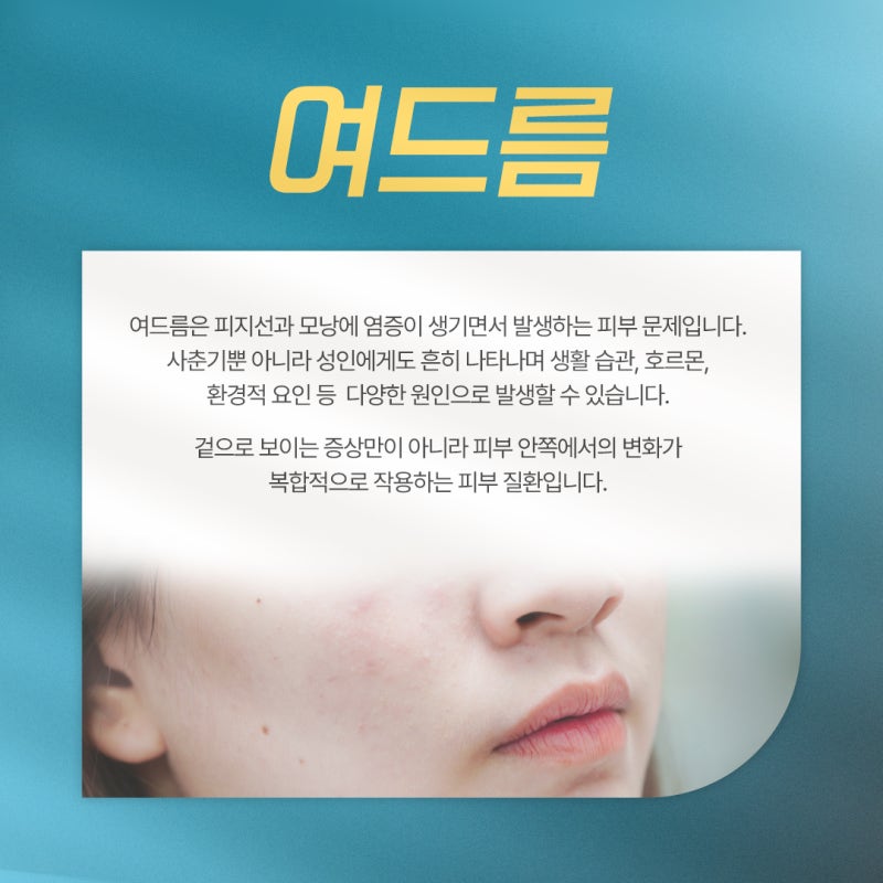 반복되는 트러블, 방배동 여드름 원인과 관리 방법