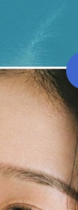 서초 기미 치료, 제대로 효과 보기 위해서는? 사진 12