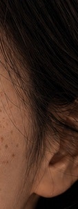 반포동 색소 치료, 더 진해지기 전에 확인하세요. 사진 22