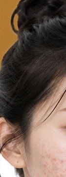 옅어졌던 흉터가 다시 진해진다면? 고속터미널역 피부과 상담 팁 사진 17