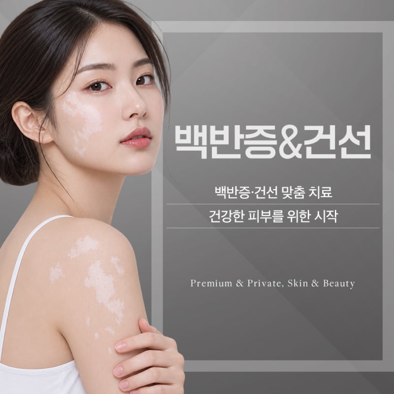 서초 백반증, 흰 반점이 보인다면 먼저 확인해야 할 것들 사진 2