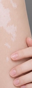 서초 백반증, 흰 반점이 보인다면 먼저 확인해야 할 것들 사진 25