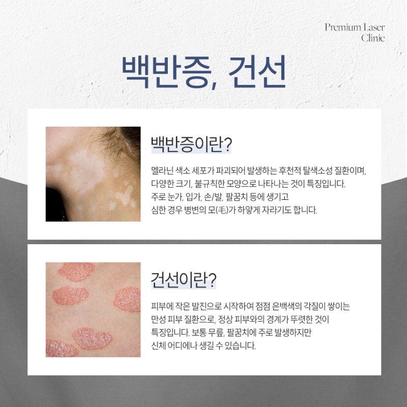 서초 백반증, 흰 반점이 보인다면 먼저 확인해야 할 것들