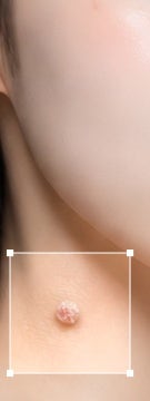 신반포역 사마귀 정확한 구별이 먼저인 이유 사진 16