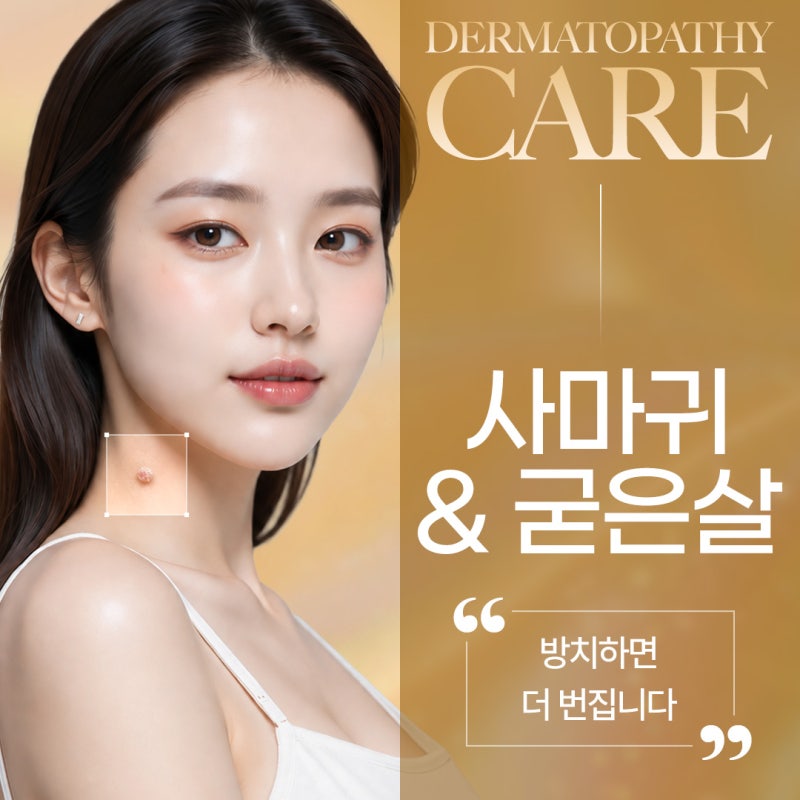 신반포역 사마귀 정확한 구별이 먼저인 이유 사진 2