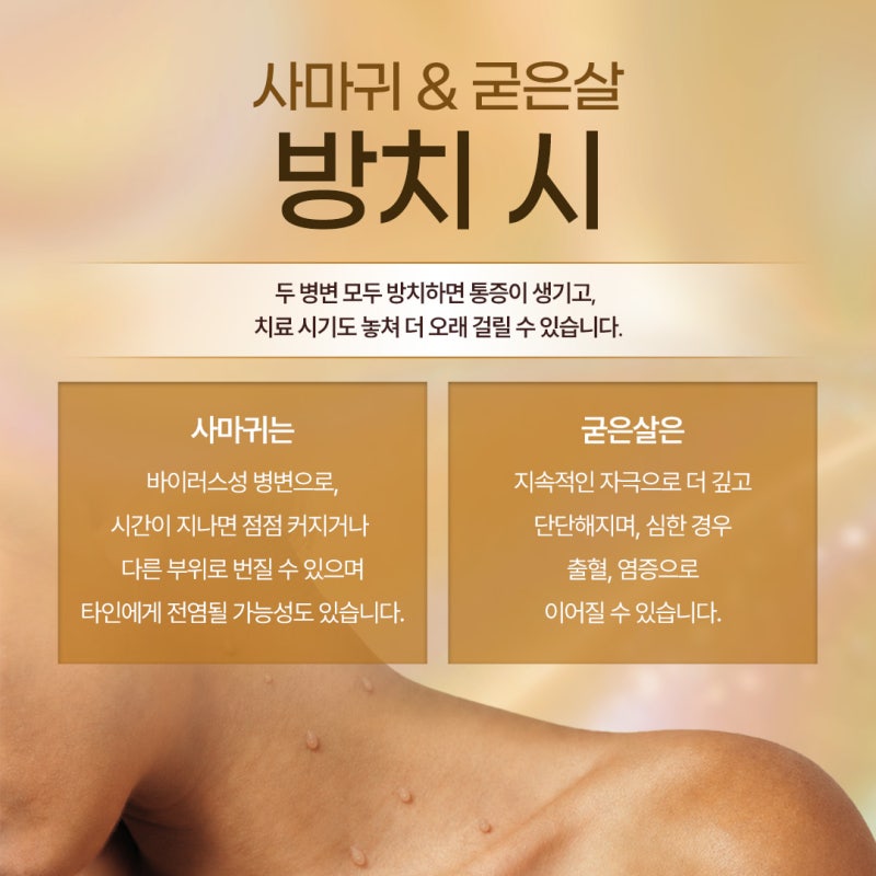 신반포역 사마귀 정확한 구별이 먼저인 이유 사진 4